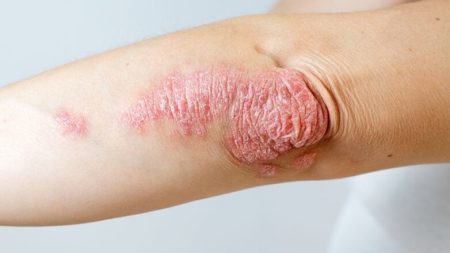 Ψωρίαση: Όλα όσα πρέπει να γνωρίζετε