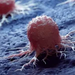 Οι μικροσκοπικές μεταλλικές νανοκουκκίδες εξαφανίζουν τα καρκινικά κύτταρα ενώ σε μεγάλο βαθμό εξοικονομούν υγιή ιστό