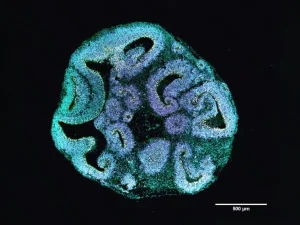 Μια μικρή μετάλλαξη μπορεί να διαταράξει την ανάπτυξη του εγκεφάλου για μια ζωή