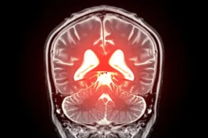 Ένα μόριο του εγκεφάλου που λείπει μπορεί να προκαλεί αγγειακή άνοια