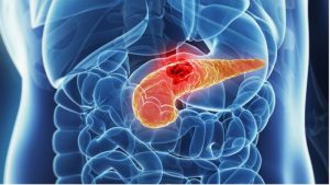 «Καρκίνος του Παγκρέατος: Τα Ύπουλα Συμπτώματα που Πρέπει να Προσέξετε!» «Καρκίνος του Παγκρέατος: Τα Ύπουλα Συμπτώματα που Πρέπει να Προσέξετε!»