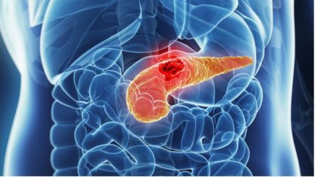 «Καρκίνος του Παγκρέατος: Τα Ύπουλα Συμπτώματα που Πρέπει να Προσέξετε!»