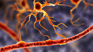 Αποκωδικοποιώντας τη Σκλήρυνση Κατά Πλάκας: Όλα όσα Πρέπει να Ξέρετε!