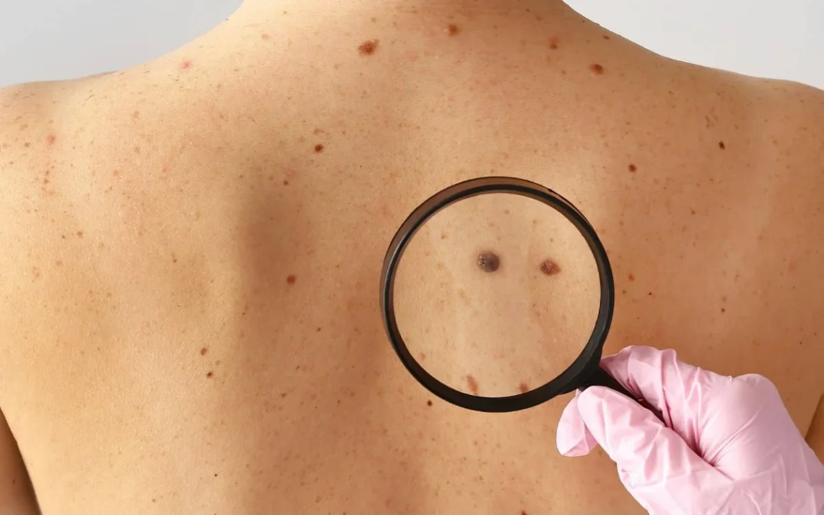 Απίστευτο: Ο ήλιος μπορεί να αποδυναμώσει την άμυνα σου κατά του καρκίνου του δέρματος! Απίστευτο: Ο ήλιος μπορεί να αποδυναμώσει την άμυνα σου κατά του καρκίνου του δέρματος!