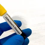 Οι εξετάσεις αίματος αποκαλύπτουν πόσο γρήγορα η παχυσαρκία επιταχύνει το Αλτσχάιμερ