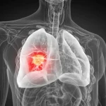 Πώς η φλεγμονή υπερφορτίζει έναν από τους πιο θανατηφόρους καρκίνους