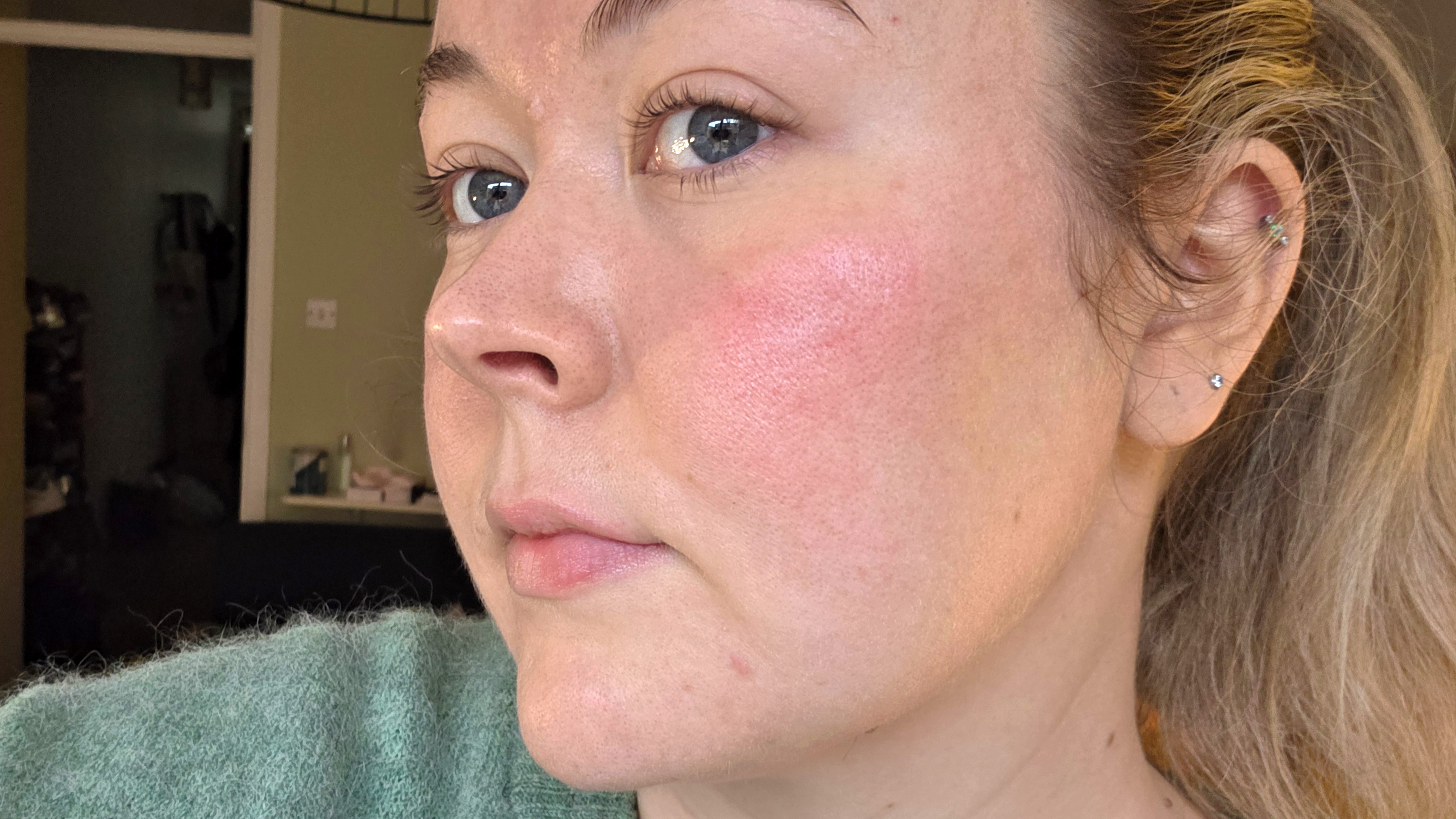 «Shark CryoGlow: Η Ανακαλυψη που Υπόσχεται Θαύματα – Πραγματικά Λειτουργεί ή Είναι Απάτη;» στενό δέρμα μετά τη χρήση της μάσκας Shark CryoGlow