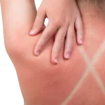 Οι επιστήμονες ανακαλύπτουν πώς το ηλιακό έγκαυμα προκαλεί μια κρυφή αλυσιδωτή αντίδραση καρκίνου