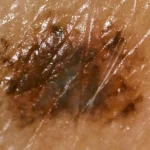 «Ανακαλύφθηκε το Πρώτο Gel που Επανορθώνει Καρκινικές Πληγές – Το Μυστικό που θα Σοκάρει τηΜαθηηκή Κοινότητα!»