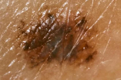 «Ανακαλύφθηκε το Πρώτο Gel που Επανορθώνει Καρκινικές Πληγές – Το Μυστικό που θα Σοκάρει τηΜαθηηκή Κοινότητα!»