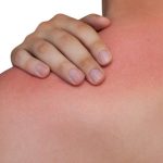 «Σοκαριστικό: Πώς το ηλιακό έγκαυμα καταστρέφει την φυσική άμυνα του σώματός σας και αυξάνει τον κίνδυνο καρκίνου του δέρματος!»