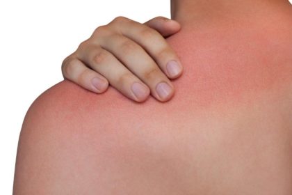 «Σοκαριστικό: Πώς το ηλιακό έγκαυμα καταστρέφει την φυσική άμυνα του σώματός σας και αυξάνει τον κίνδυνο καρκίνου του δέρματος!»