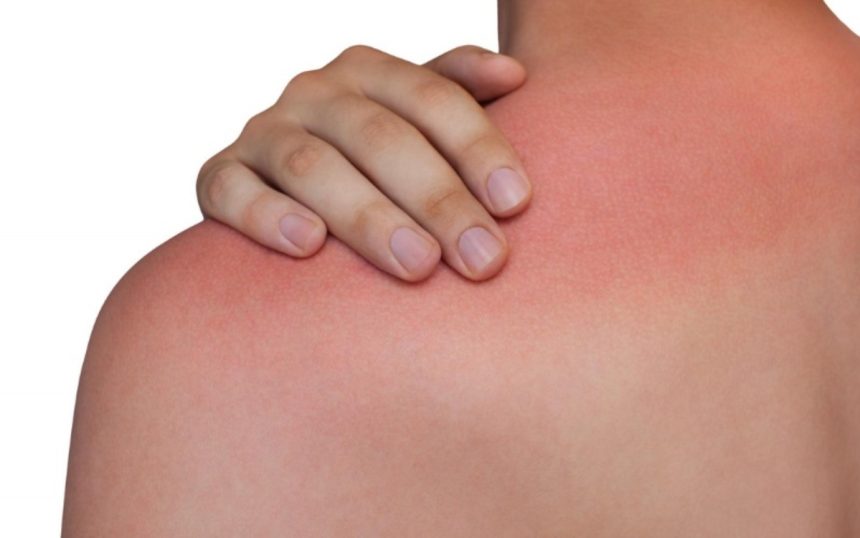 «Σοκαριστικό: Πώς το ηλιακό έγκαυμα καταστρέφει την φυσική άμυνα του σώματός σας και αυξάνει τον κίνδυνο καρκίνου του δέρματος!»