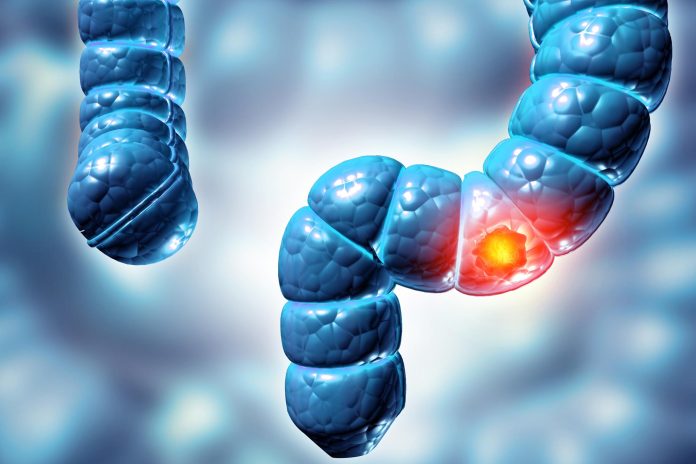 Ανακαλύφθηκε μυστικός ιός που μπορεί να προκαλεί καρκίνο του παχέος εντέρου!