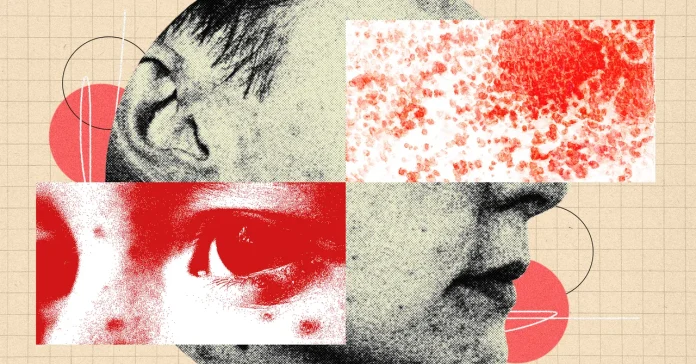 «Γιατί ο έρπης ζωστήρας είναι πιο ανησυχητικός απ' ό,τι νομίζετε»