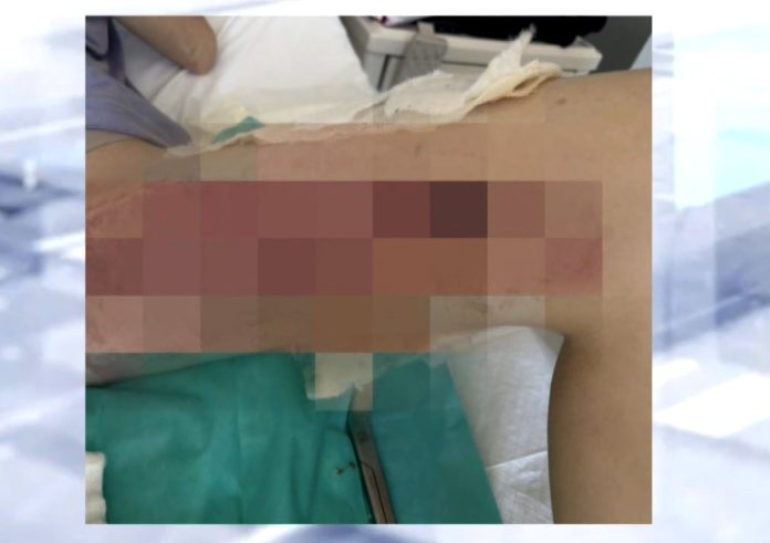 Θεσσαλονίκη: 20χρονη με εγκαύματα από επέμβαση κόκκυγα Θεσσαλονίκη: 20χρονη με εγκαύματα από επέμβαση κόκκυγα